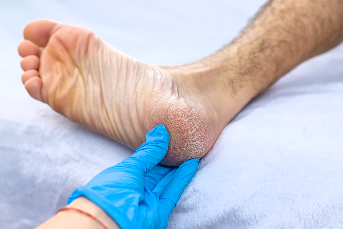 Cracked Heels and Heel Fissures | Foot & Ankle